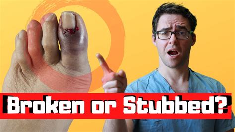 Stubbed Toe Or Broken Toe Symptoms Pain Relief And Treatment Youtube