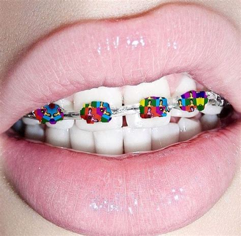 Pin By Virjni T On Pastels Dental Braces Lip Art Cute Braces Colors