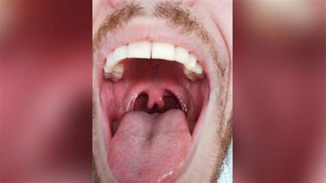 Photo Of Mans Double Uvula Goes Viral