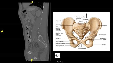 Sagittal Ct Of Pelvis And Lumbar Spine Youtube