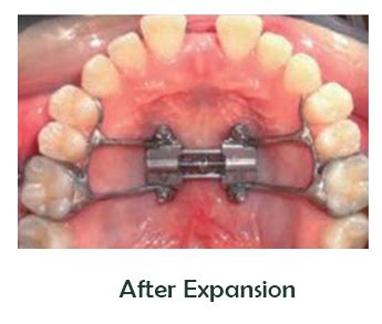 Miniscrew Assisted Rapid Palatal Expansion Marpe Smile Design