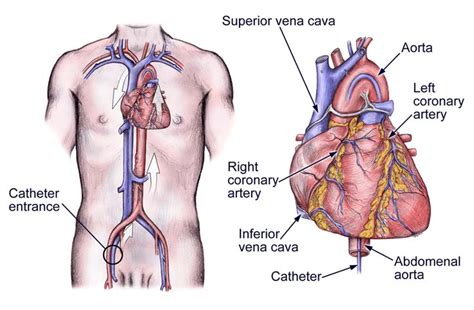 image detail for cardiac catheterization left heart cardiac catheterization cardiac heart