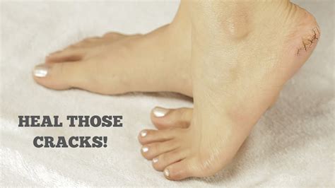 How To Heal Cracked Heels At Home Take A Shower Or Wash Your Feet Before Bed Then Apply A