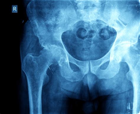 Hip Osteoarthritis May Not Appear On X Ray