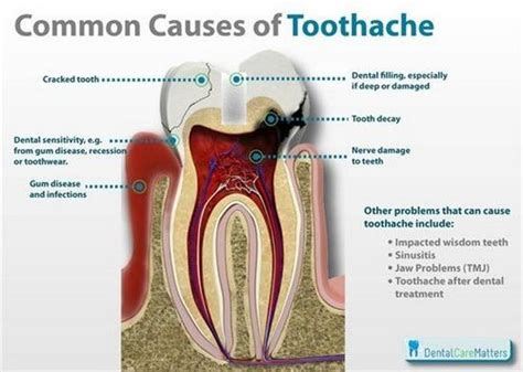 Toothache Cause Symptoms And Treatment Dentist Lentrodt Christina