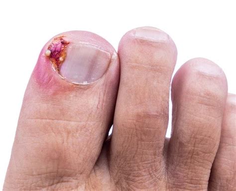 A Step By Step Guide How To Remove Ingrown Toenail