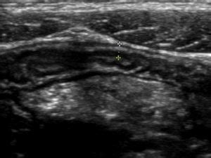 I've been bleeding irregular between periods but this month has been for 5 days straight after my period. Normal gut ultrasound - Critical Care Sonography