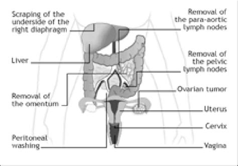 Procedures Required For Surgical Staging Of Ovarian Cancer Download