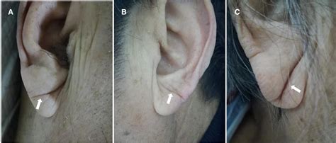 Figure 1 From The Prognostic Value Of Deep Earlobe Creases In Patients