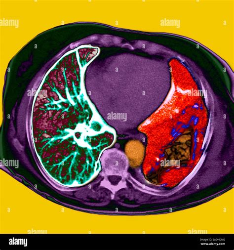Lung Cancer Coloured Computed Tomography Ct Scan Of An Axial Section