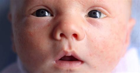 Does My Baby Have Acne Or A Rash Diagnosis And Treatment