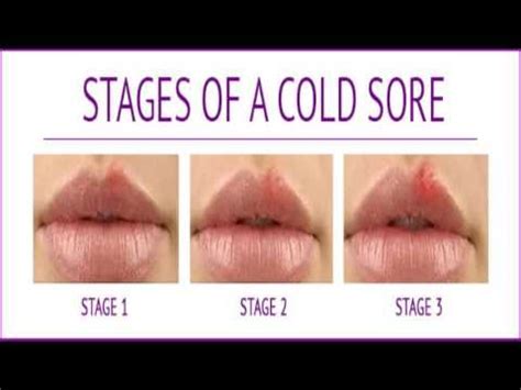 Take the extra preventative steps to cut back on the intensity. cold sore on lip or pimple best cold sore treatment - YouTube