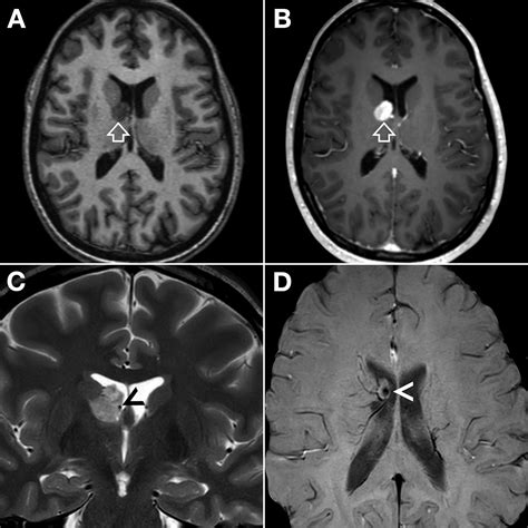 Solitary Subependymal Giant Cell Astrocytoma Case Report And Review Of