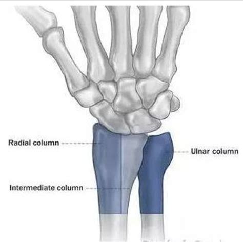 Illustration Of Distal Radius Die Punch Fracture Locates In The Ulnar