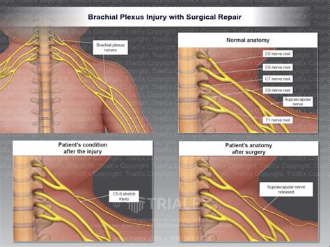 Brachial Plexus Injury With Surgical Repair Trial Exhibits Inc