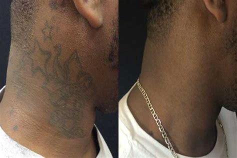 Neck Tattoo Removal Laser Tattoo Removal Removery