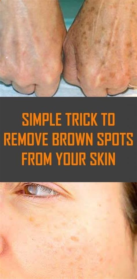 Simple Trick To Remove Brown Spots From Your Skin Brown Spots On Skin