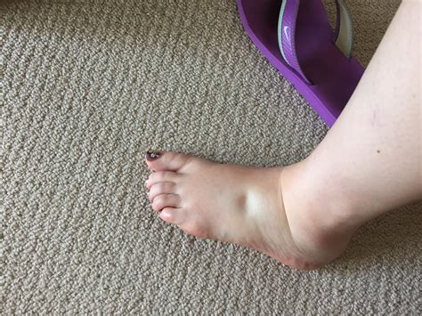 Pitting Edema In Feet — The Bump