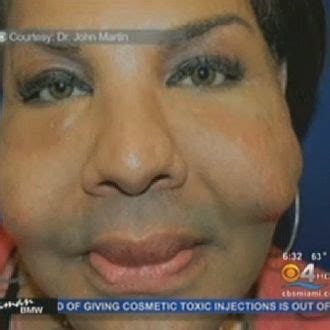 See A Botched Plastic Surgery Victim Whose Face Might Be Filled With Cement