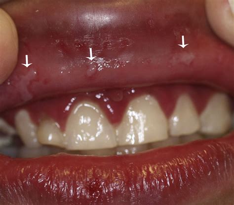 Update On Oral Herpes Virus Infections Dental Clinics