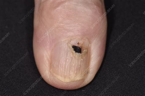 Fungal Nail Infection Stock Image C0549377 Science Photo Library