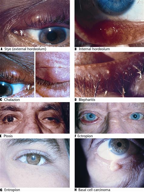 Eyelid Disorders American Academy Of Ophthalmology