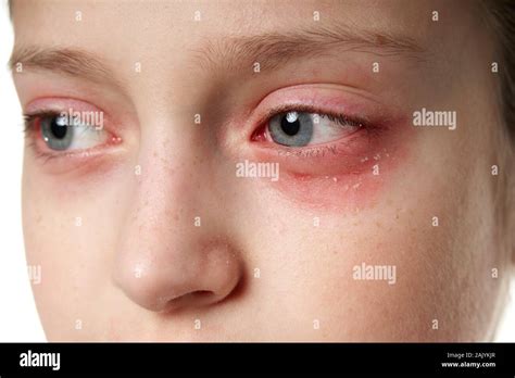 Allergic Reaction Eyes Hi Res Stock Photography And Images Alamy