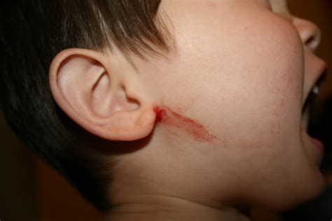 Ear Bleeding At Night Causes And Treatments 2024