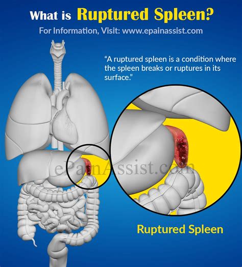Ruptured Spleen Causes Signs Symptoms Tests Treatment Prevention