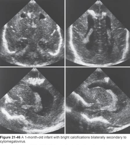 Chapter 21 Neonatal Neurosonography Pathology Part 3 Flashcards