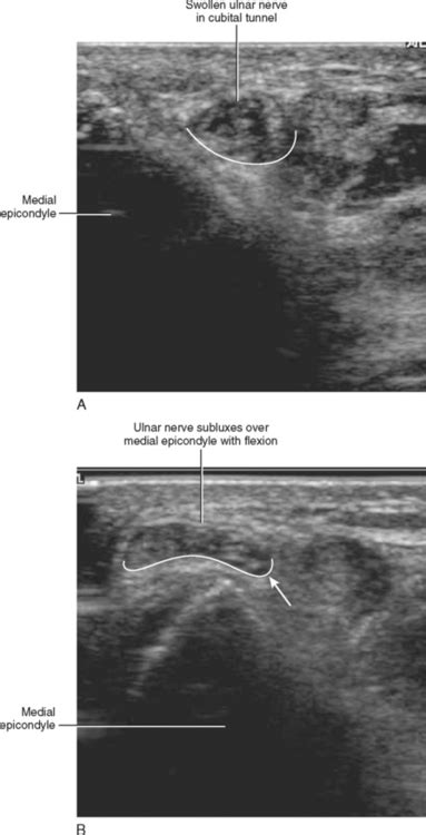 Ulnar Nerve Ultrasound Elbow