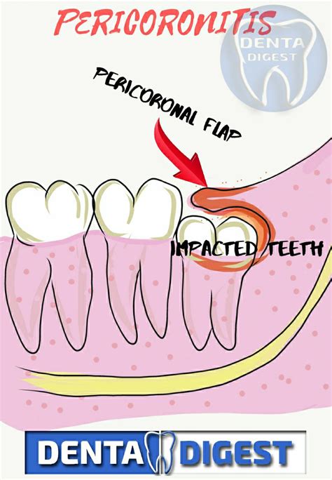 Wisdom Tooth Infection A Patients Guide To Manage Pericoronitis