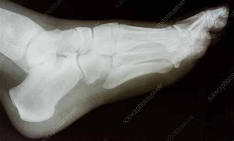 X Ray Lateral View Of Left Foot Stock Image C0503902
