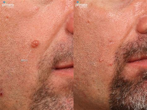 Sebaceous Cyst Face Removal