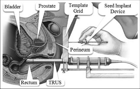 Prostate Milking Procedure Telegraph