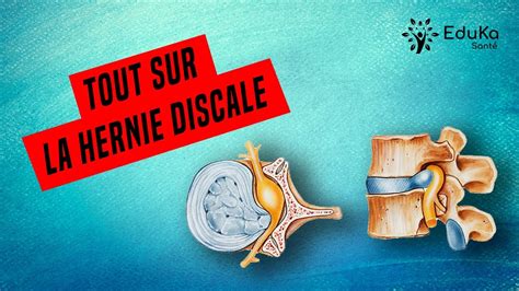 Hernie Discale Lombaire Tout Savoir Sur Les Traitements Exercices Hot