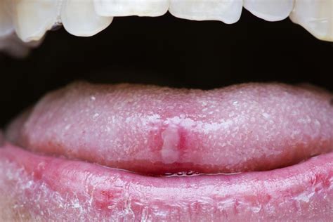 Sore Tongue Causes And Tongue Care Tips