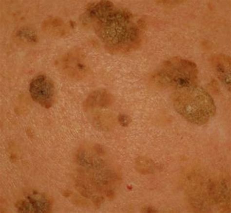 Seborrheic Keratosis Pictures Symptoms Treatment Removal And Causes