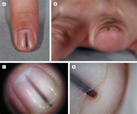 Onychocytic Matricoma A New Important Nail Unit Tumor Mistaken For A