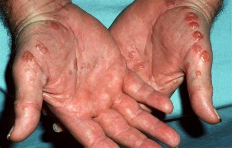 What causes eczema in the first place? Eczema - Hand, Face, Baby, Causes, Symptoms & Treatment