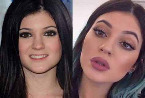 Kylie Jenner Prima E Dopo Il Chirurgo 2 Dago Fotogallery