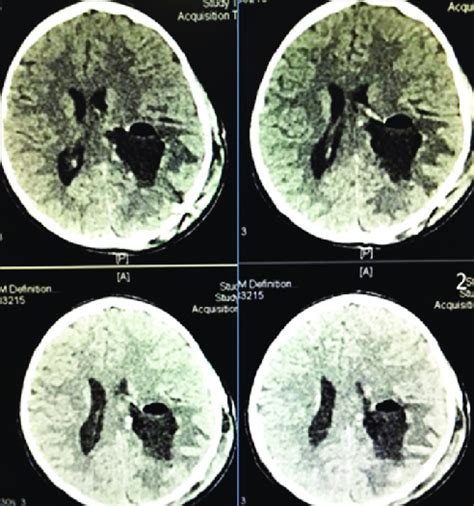 Postoperative Noncontrast Computed Tomography Head Axial Sections