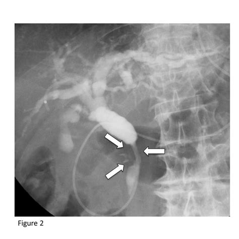 Ercp Findings Showed A Luminal Narrowing 2cm In Length In The Distal
