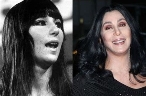 Cher Before And After Plastic Surgery 03 Celebrity Plastic Surgery Online