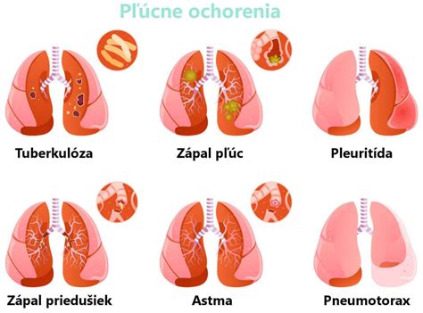 Pneum Nia Z Pal P C Pr Znaky Lie Ba Inkuba N Doba Zdravovek