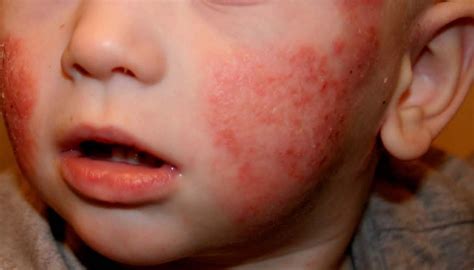 Advierten sobre aumento de niños con dermatitis atópica DiarioSalud do