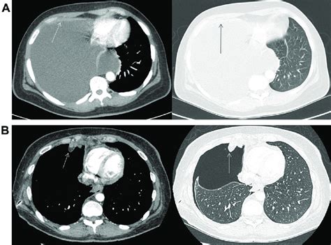 A Ct Imaging Showing Large Pleural Effusion With Possible Anterior