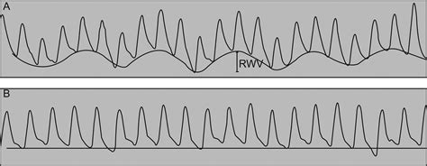 Pulse Oximetry Beyond Spo2 Respiratory Care