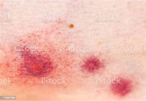 Severe Allergic Reaction To Mosquito Bite Stock Photo Download Image