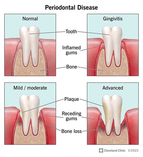 Periodontal Disease Gum Disease Causes Symptoms And Treatment